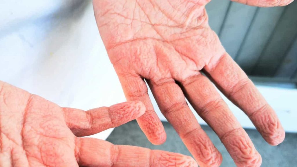 Fingers wrinkled?  Recovered from Covid-19 Report new symptoms