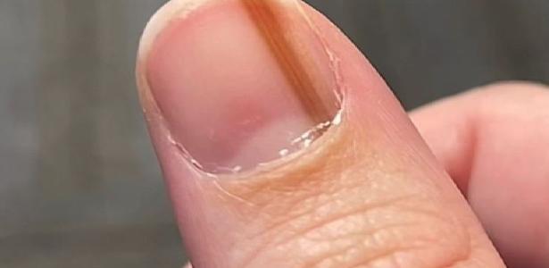 Woman discovers nail cancer after living for years with an unusual spot
