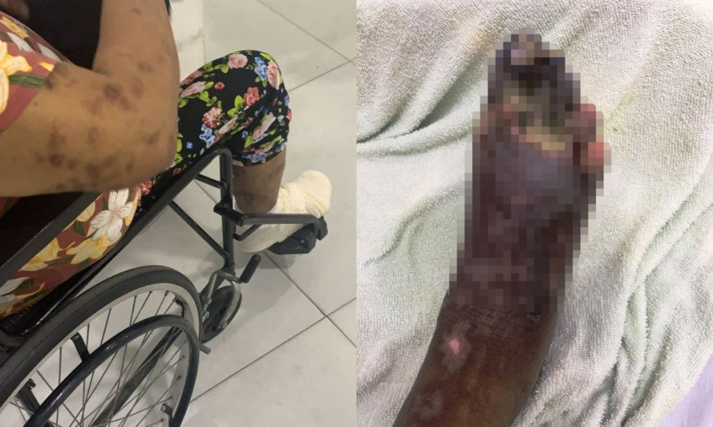 Woman sees necrosis in her leg after injury to her foot and fights nine days to get care in SP: 'real neglect' |  More health