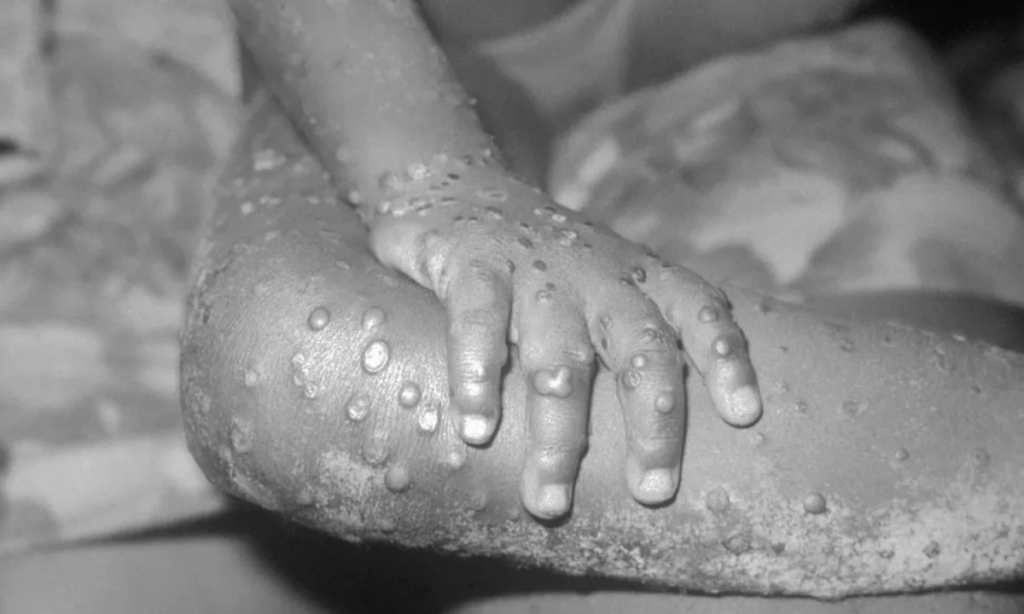 WHO - iBahia.com - Nearly 100 cases of monkeypox confirmed outside the endemic area