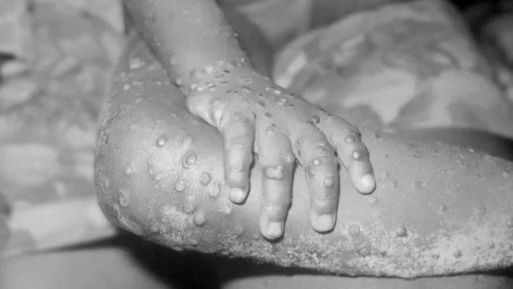 Monkeypox: What is known about rare viral infection in two more cases in England |  health