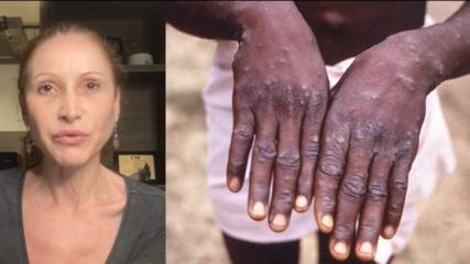 Monkeypox: Understand what is already known about the disease