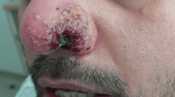 Infection of the nose with smallpox