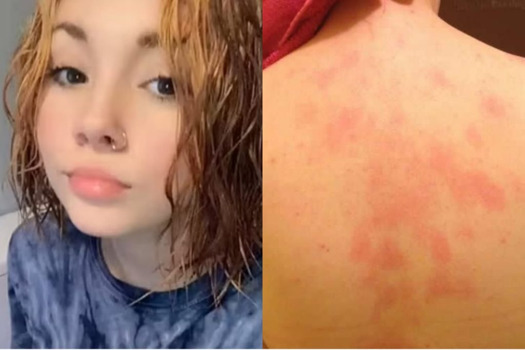 Teen comes out of the bathroom with red skin, rushes to the hospital, gets a scary diagnosis