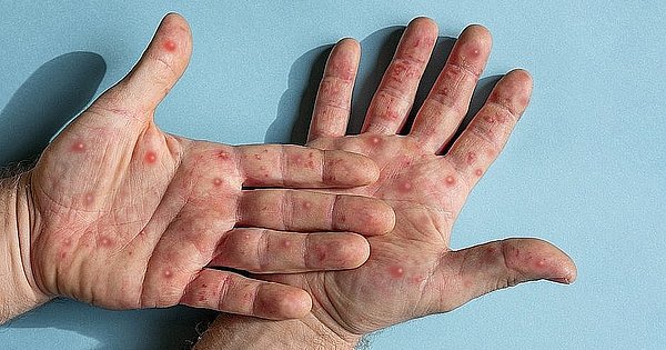 With 33 new cases, Baheya contracted monkeypox 101