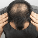 3 Myths About Baldness And Why It’s Not ‘Necessarily Bad’ According To An Expert – 06/12/2022