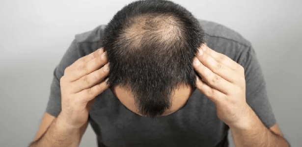 3 Myths About Baldness And Why It's Not 'Necessarily Bad' According To An Expert - 06/12/2022